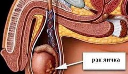 Рак яичка