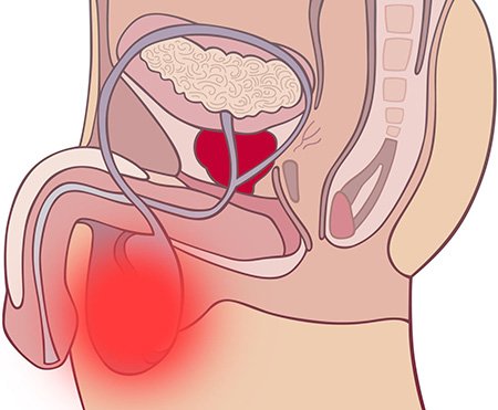 Фото:Опухание яичек у мужчин: причины и лечение