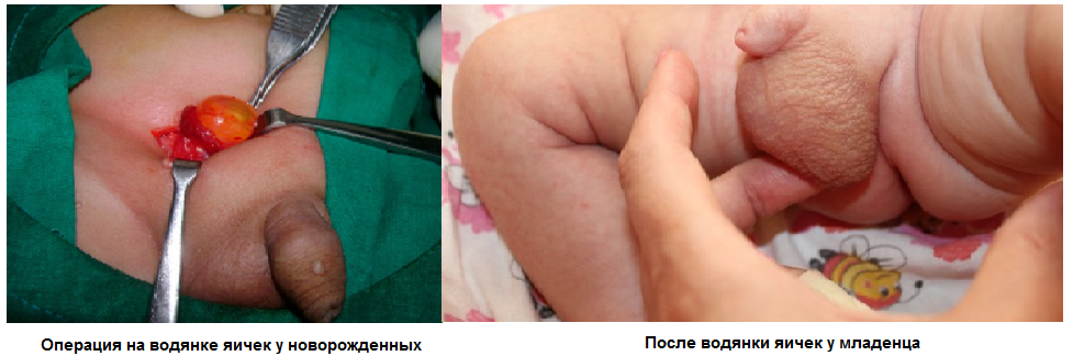 Фото:Водянка яичек у мальчиков: фото после лечения
