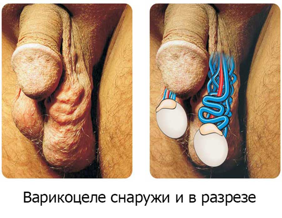 Фото:Варикоцеле: причины и симптомы для других болезней